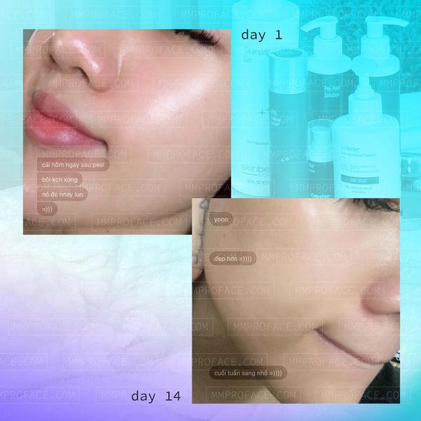 Peel da cân bằng và phục hồi Skinbetter AlphaRet Professional Peel 30