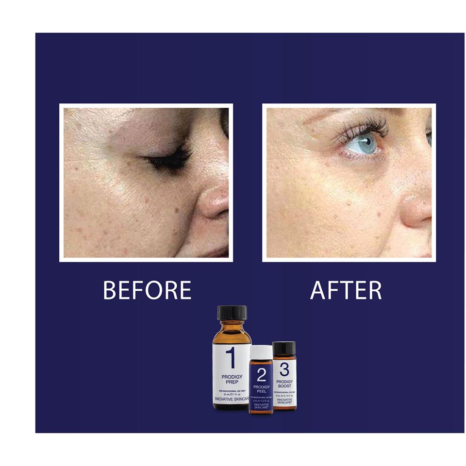Peel da chuyên sâu giảm sắc tố và trẻ hóa da iS Clinical Prodigy Peel P2