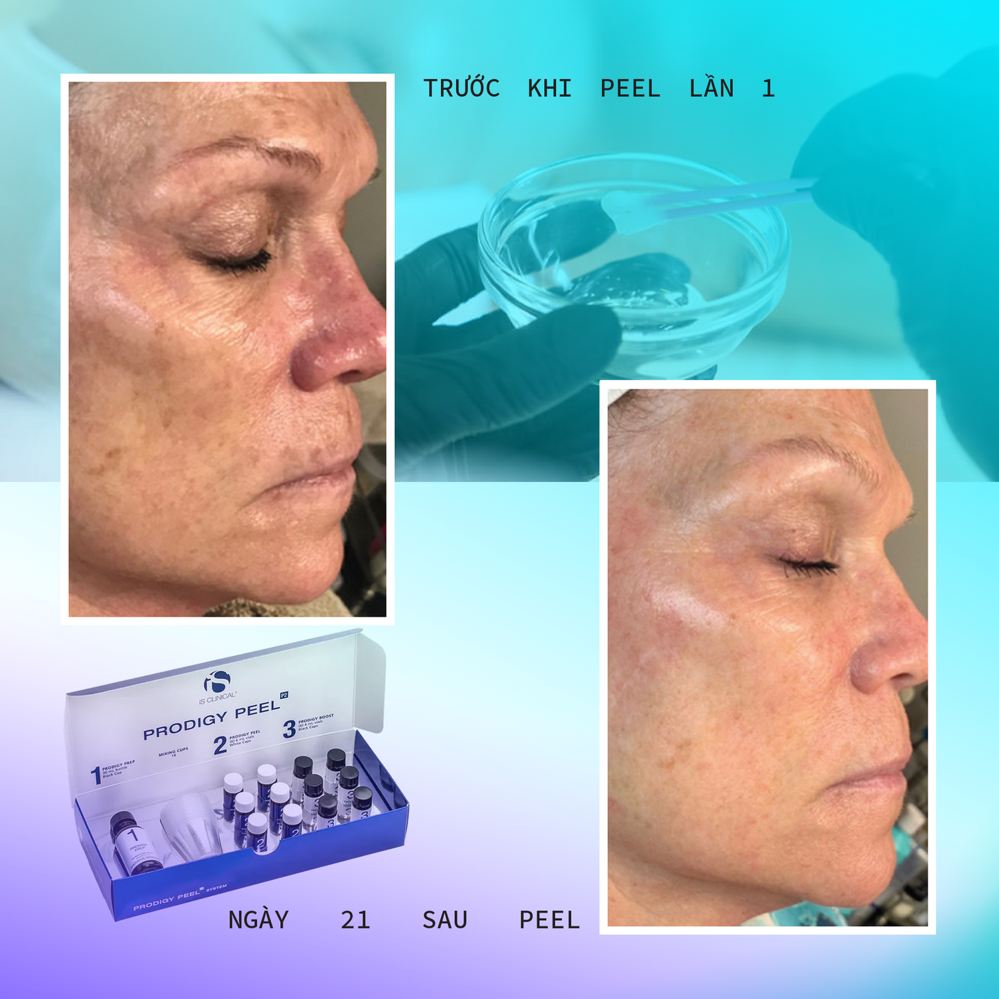Peel da chuyên sâu cải thiện sắc tố và đảo ngược lão hóa toàn diện iS Clinical Prodigy Peel PRO P3