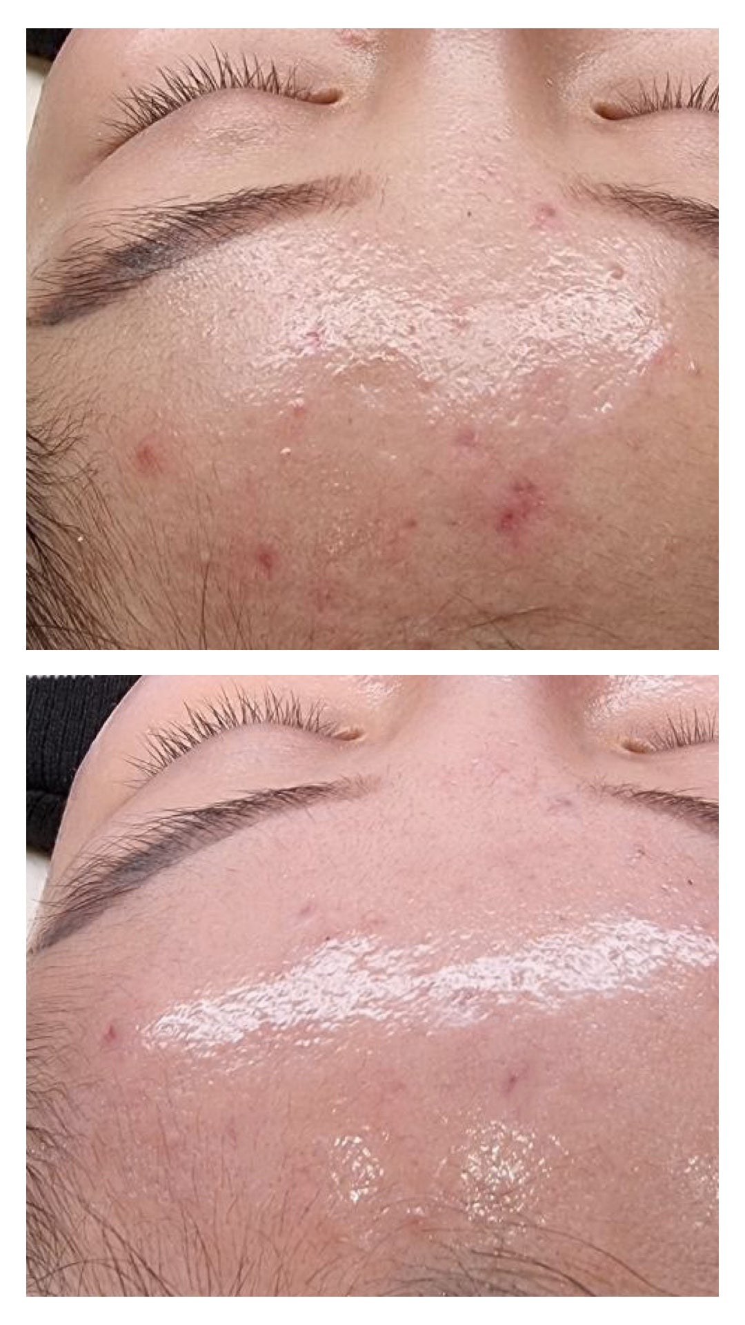 Peel da trị mụn Medik8 Cocktail Peel - Clarity