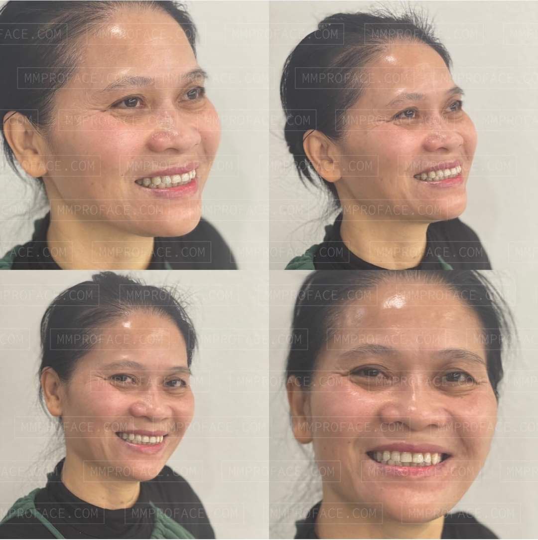 Peel da tăng cường sức khỏe làn da Skinbetter AlphaRet Professional Peel System 50