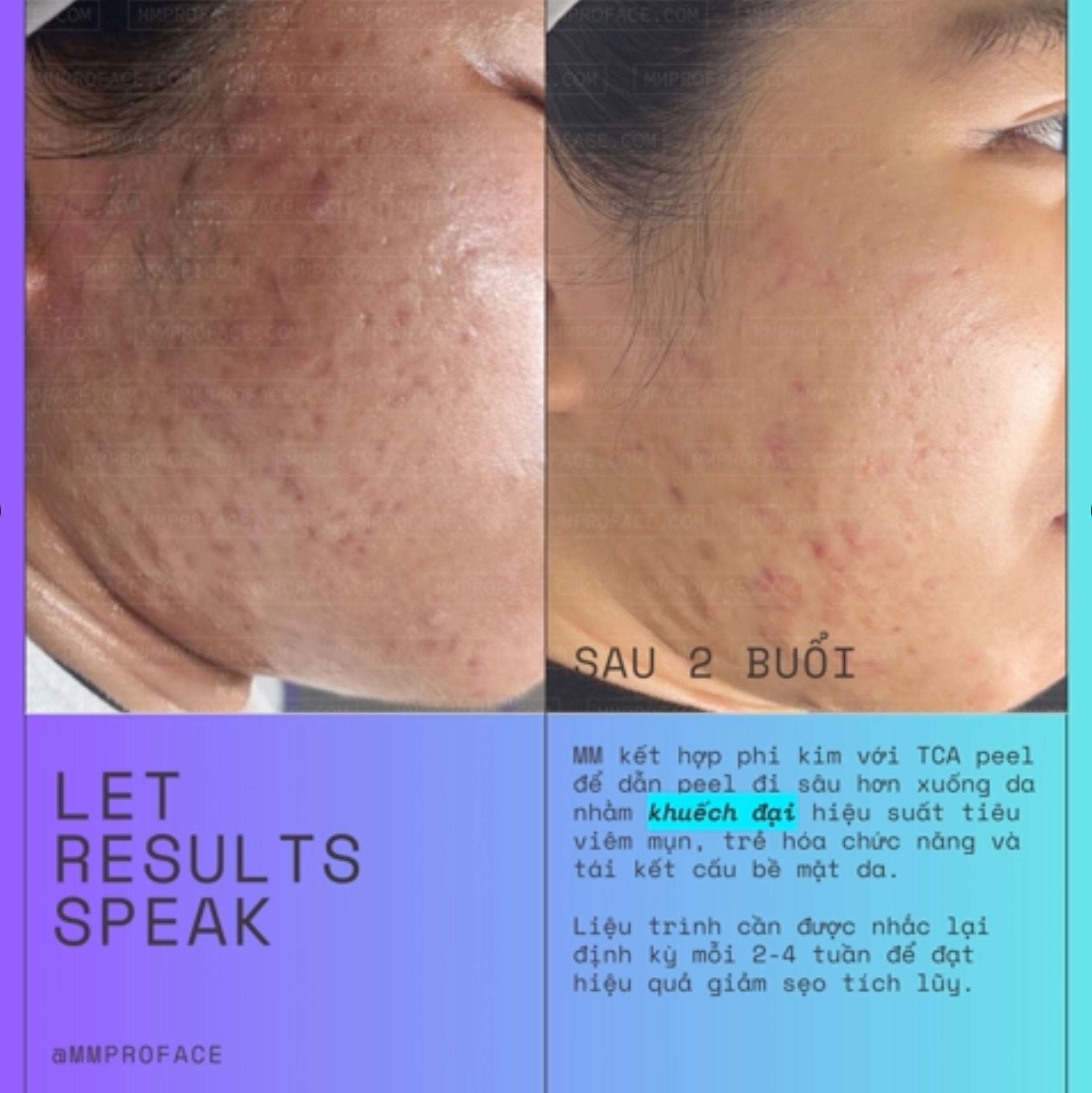 Peel da trị sẹo và trẻ hóa toàn diện WIQO PRX-T33